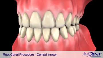 Root_Canal_Procedure_-_Central_Incisor.mp4