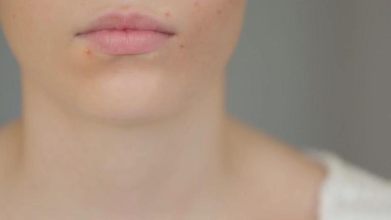 Pickel am Mund: Das verrät dein Gesicht über deine Gesundheit