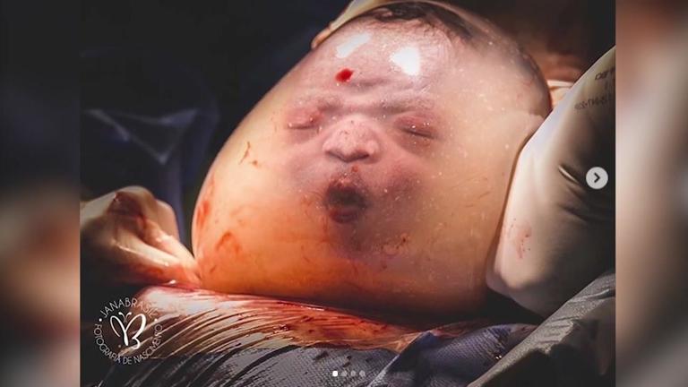 Baby kommt in Fruchtblase zur Welt