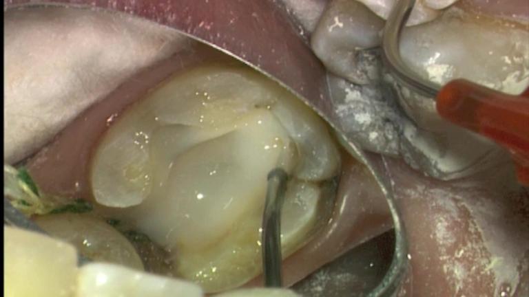 Microscope-Assisted Core Build-Up &amp; Porcelain Crown Fabrication Utilizing CEREC (CAD/CAM) Technology