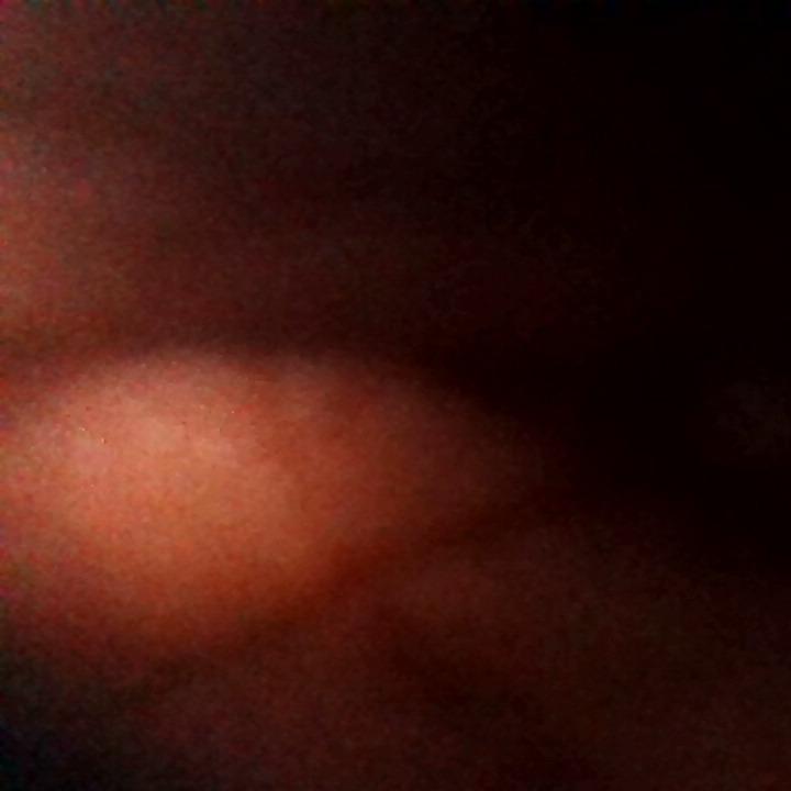 How was your post operative experience?