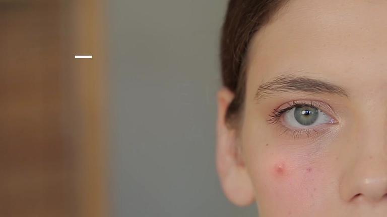 Pickel auf den Wangen: Das verrät dein Gesicht über deine Gesundheit
