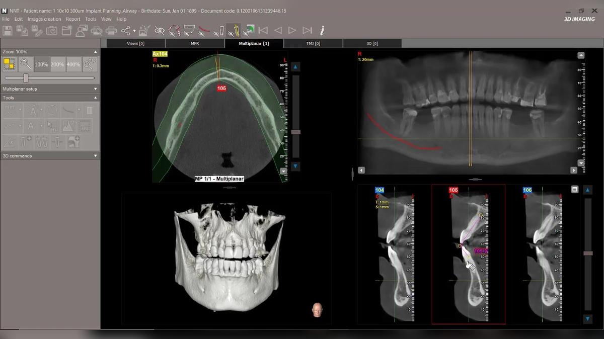 NNT 11 - Using the Angle Tool