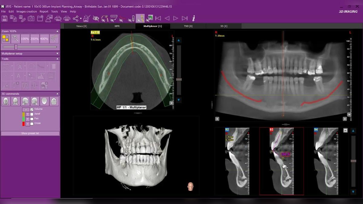 iRYS 11 - Angle Tool