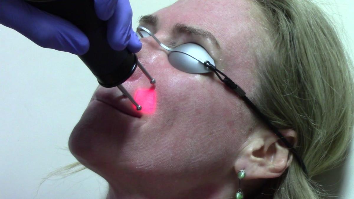 DermaBlate Overview