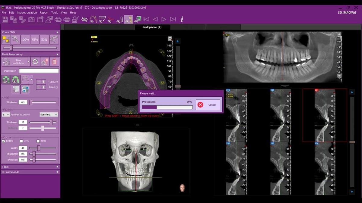 iRYS 11 - Navigating the Multiplanar Screen