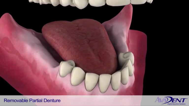 Removable_Partial_Denture.mp4