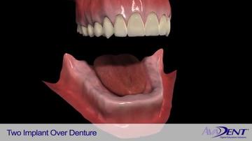 Two_Implant_Over_Denture.mp4