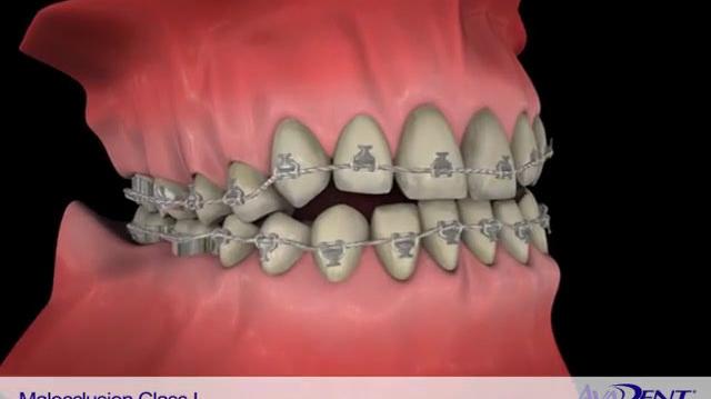 Malocclusion_Class_I.mp4