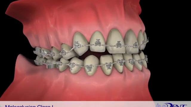 Malocclusion_Class_I.mp4