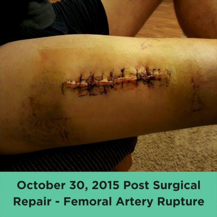 Femoral Artery Injury