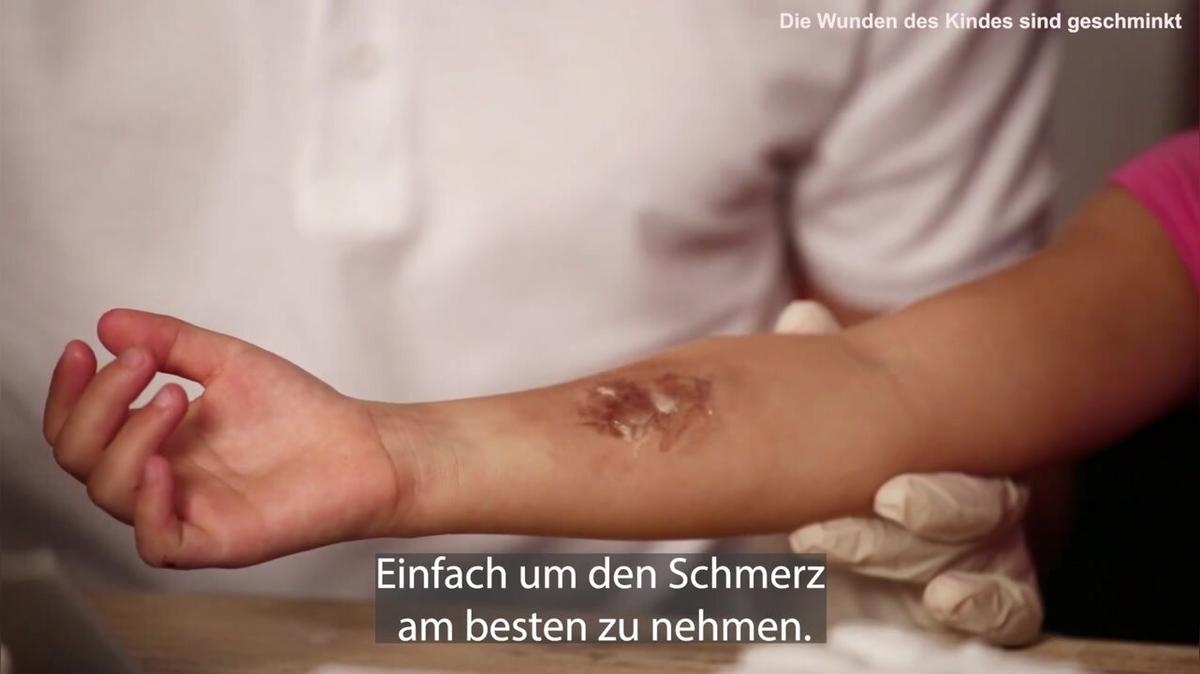 Erste Hilfe bei Kindern: Wie Versorge ich Verbrennungen/Verbrühungen