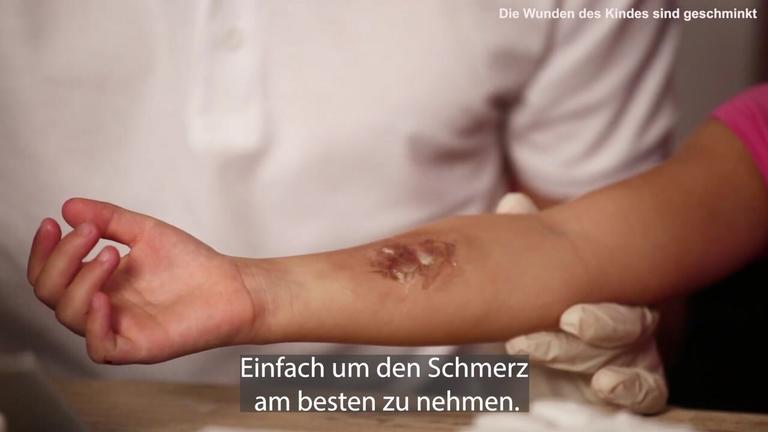 Erste Hilfe bei Kindern: Wie Versorge ich Verbrennungen/Verbrühungen