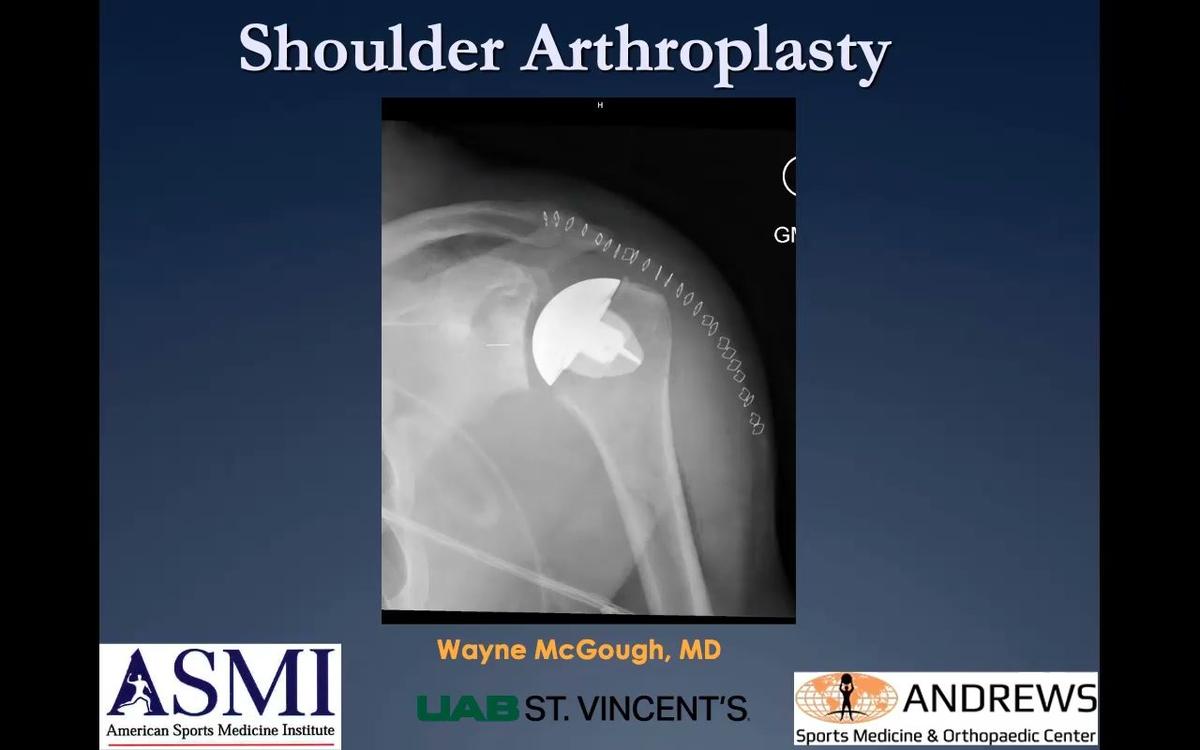 Total Shoulder Arthroplasty